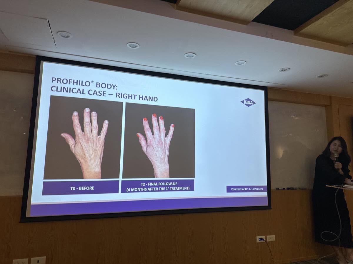PROFHILO BODY 手部回春 clinical case right hand 投影片